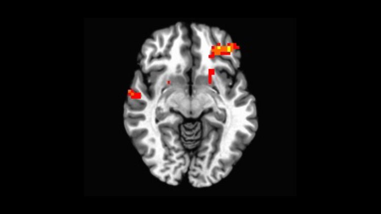 Correlation between Heightened Impulsivity and Developing Brains